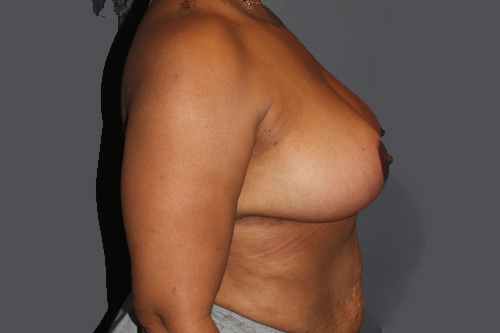 Mastopexy After Patient 2