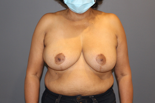 Oncoplastic Breast Surgery After Patient 3