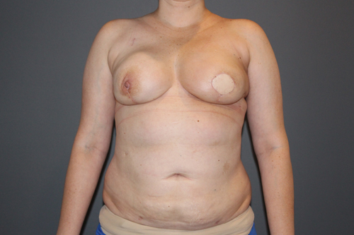 Latissimus Flap Reconstruction After Patient 2