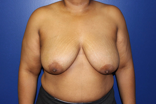 Oncoplastic Breast Surgery Before Patient 4
