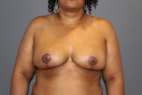 Oncoplastic Breast Surgery After Patient 4