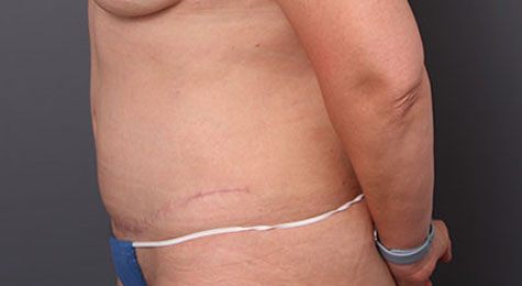 Tummy Tuck (Abdominoplasty) After Patient 1
