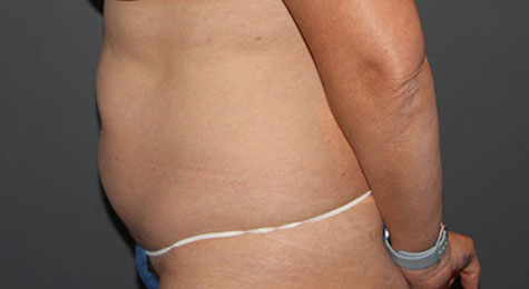 Tummy Tuck (Abdominoplasty) Before Patient 1