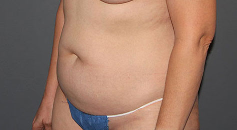 Tummy Tuck (Abdominoplasty) Before Patient 2