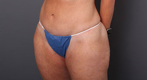 Tummy Tuck (Abdominoplasty) - Atlanta, GA - Webb Plastic Surgery
