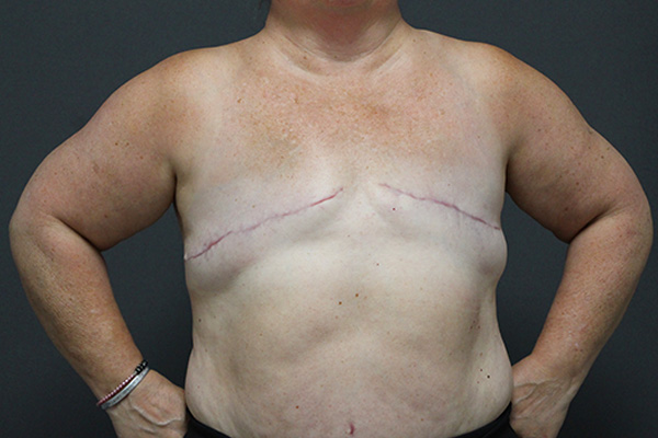 Case--1352 | After Breast Reconstruction