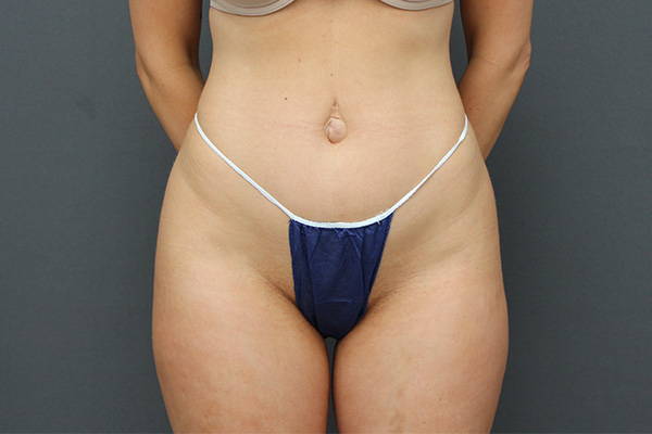 Case--4085 | Before Body Procedures