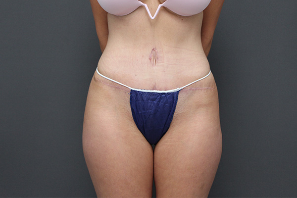 Case--4085 | After Body Procedures