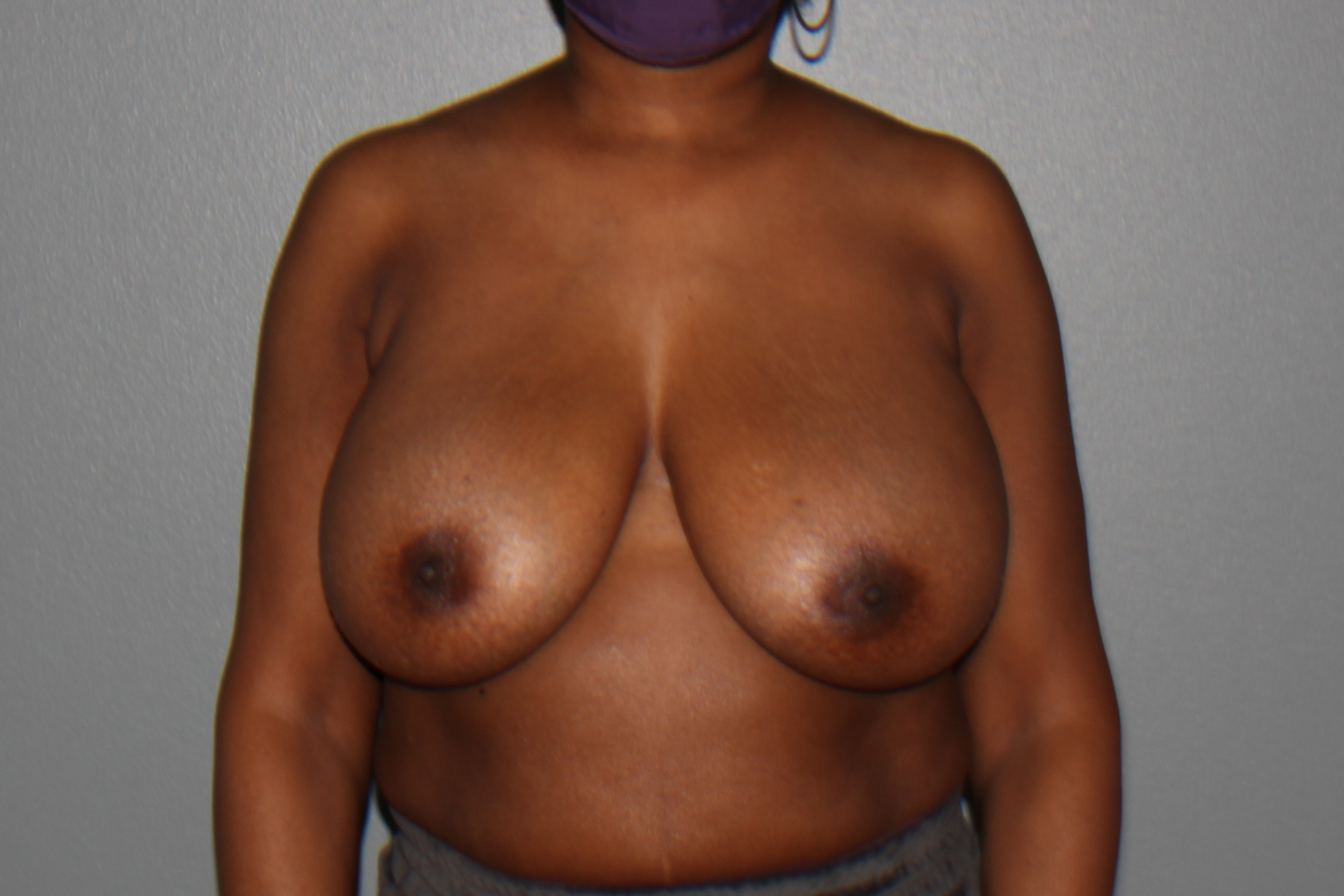 Case--5983 | Before Breast Reduction