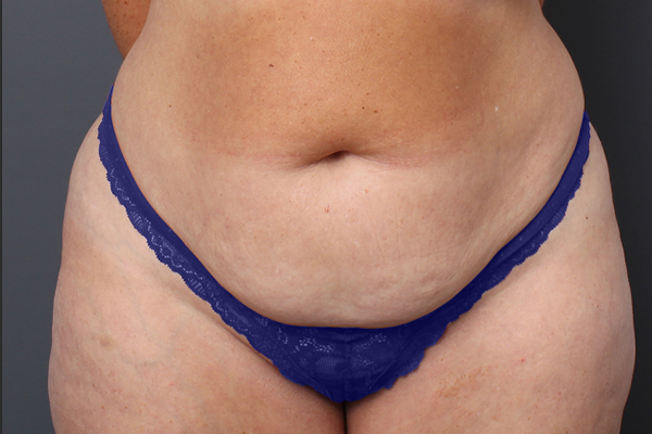 Case--7438 | Before Body Procedures