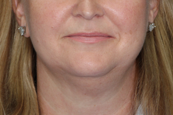 Case--8466 | Before Body Procedures