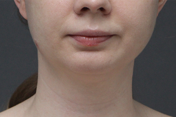 Case--9148 | Before Body Procedures