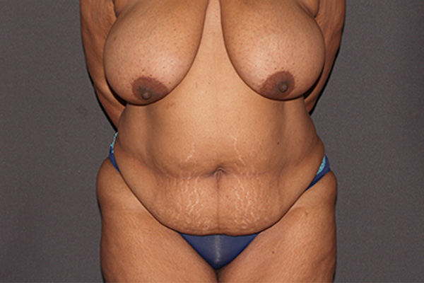 Case--6764 | Before Body Procedures