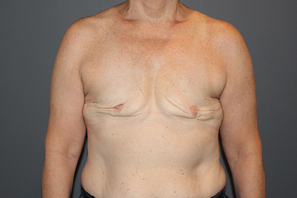 Case--1503 | Before Breast Procedures