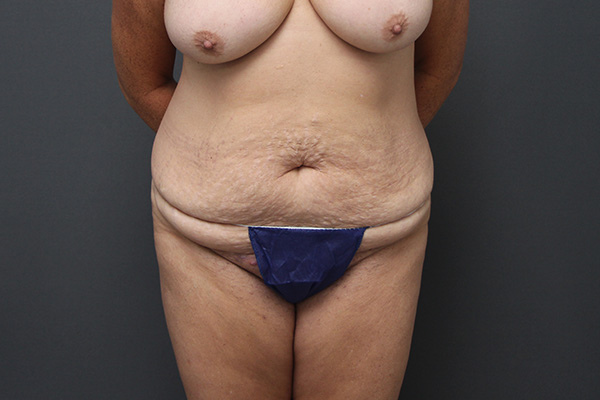 Case--7409 | Before Body Procedures