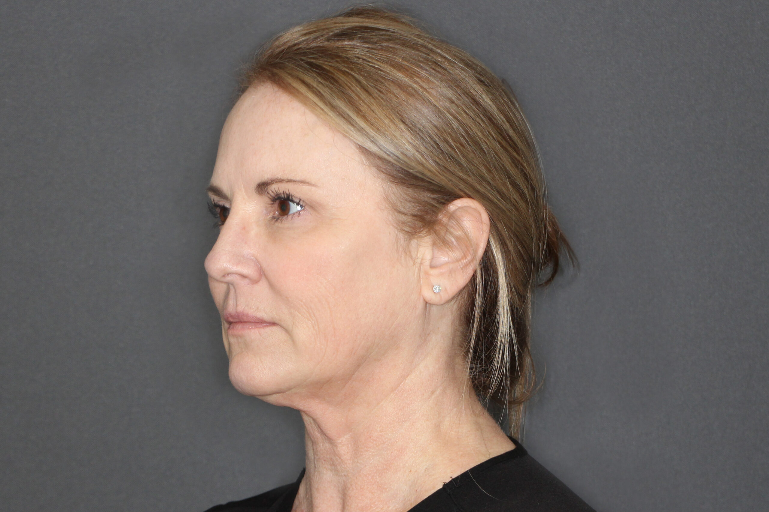 Case--1547 | After Morpheus8