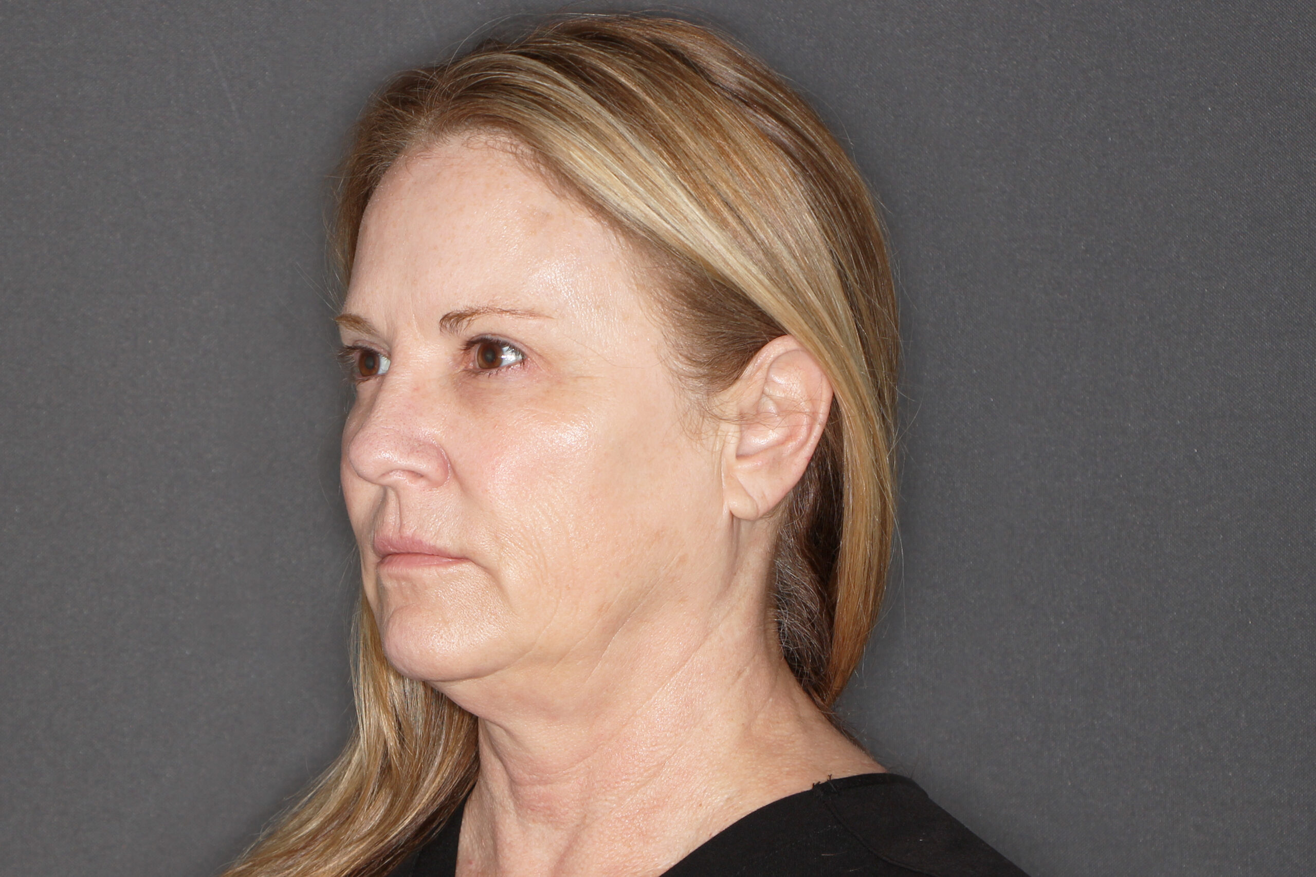 Case--1547 | Before Morpheus8