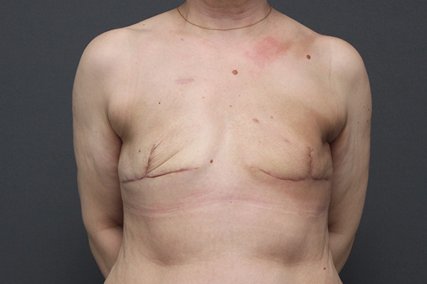 Case--3721 | After Breast Reconstruction