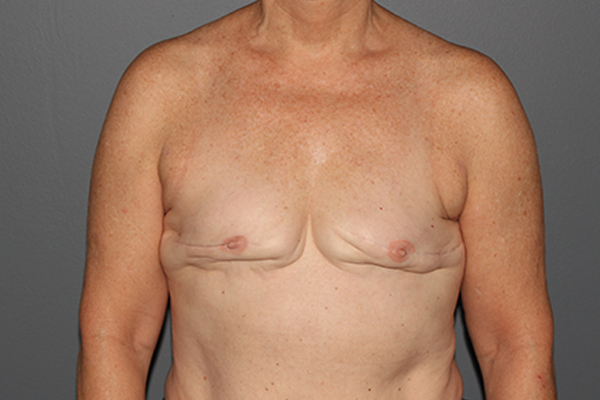 Case--1503 | After Breast Procedures