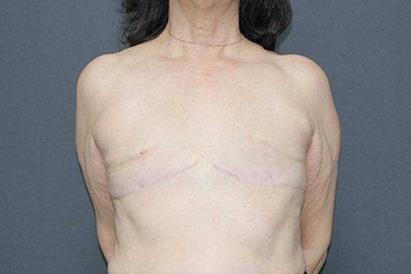 Case--1381 | After Breast Procedures