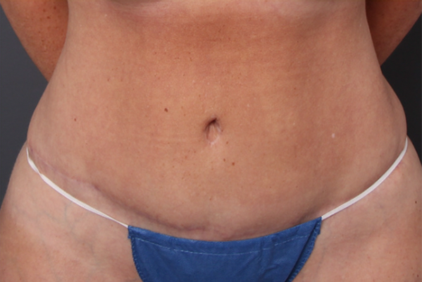 Case--7438 | After Body Procedures