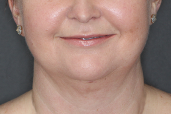 Case--8466 | After Body Procedures