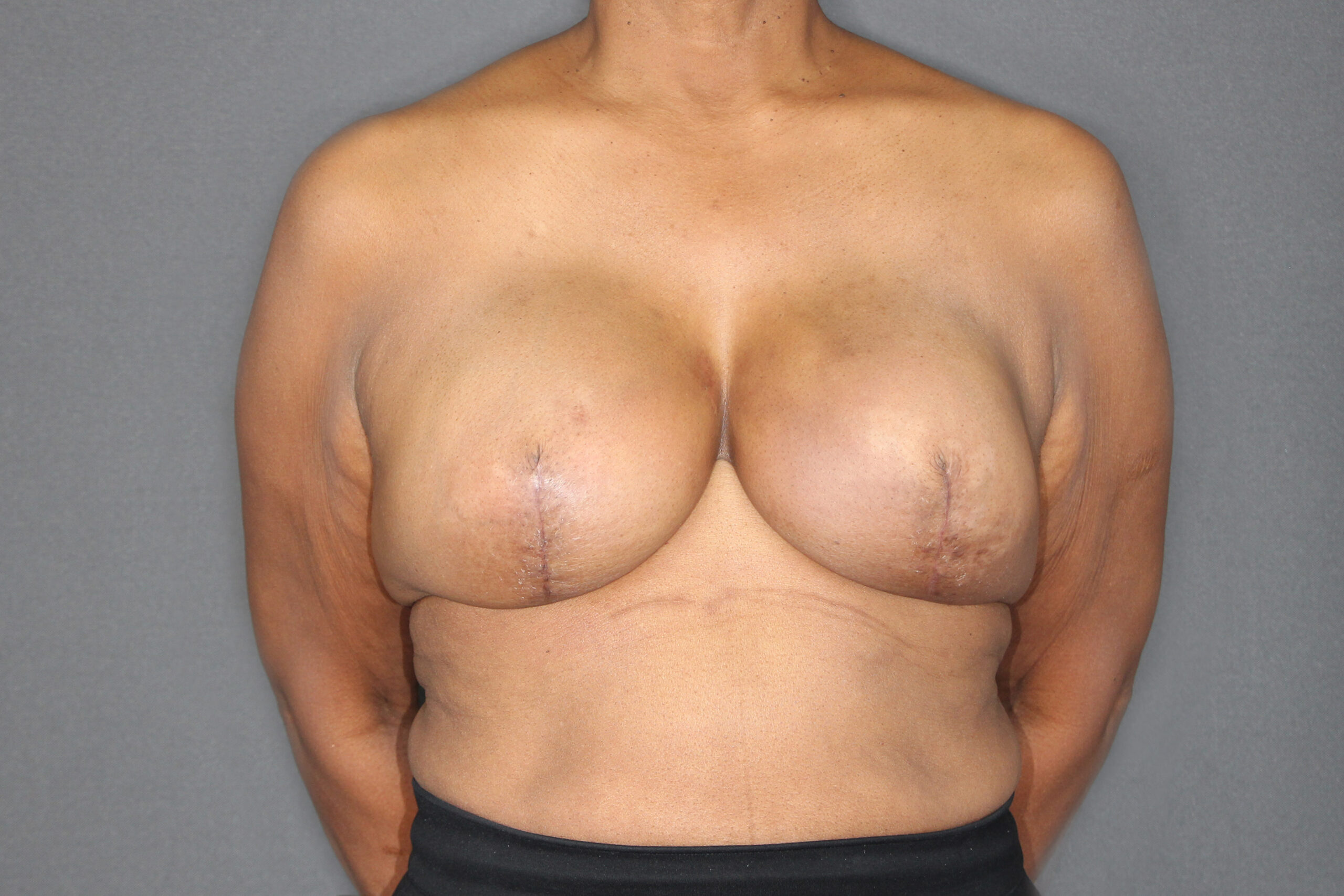Before Breast Reconstruction Revision 01
