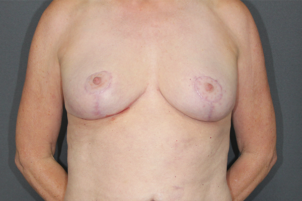 Case--1677 | After Breast Procedures