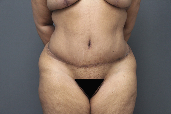 Case--6764 | After Body Procedures