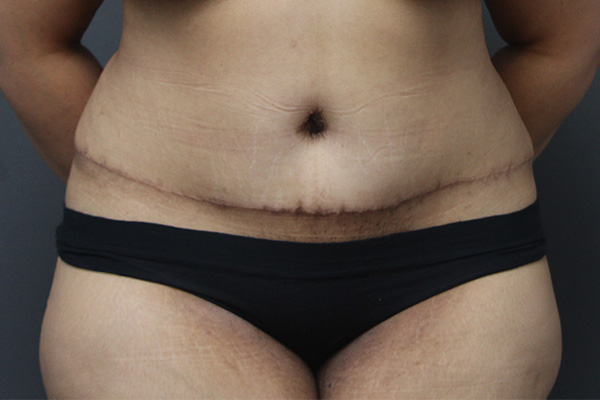 Case--8045 | After Body Procedures