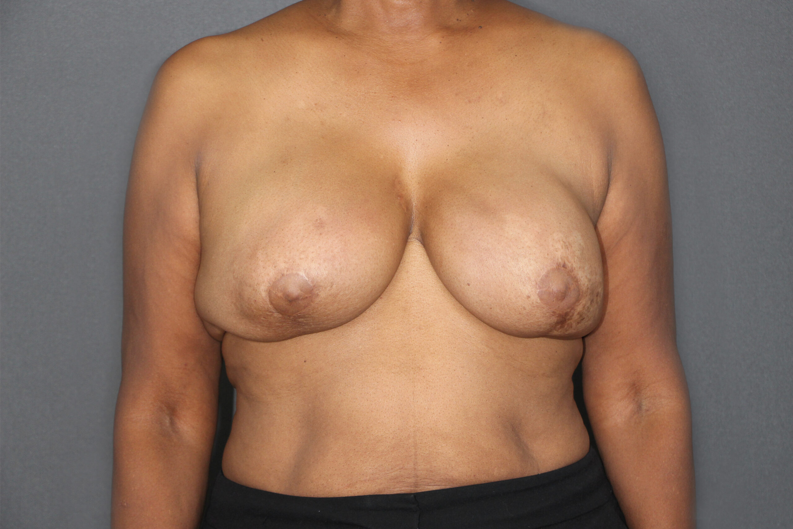 Before Breast Reconstruction Revision 01