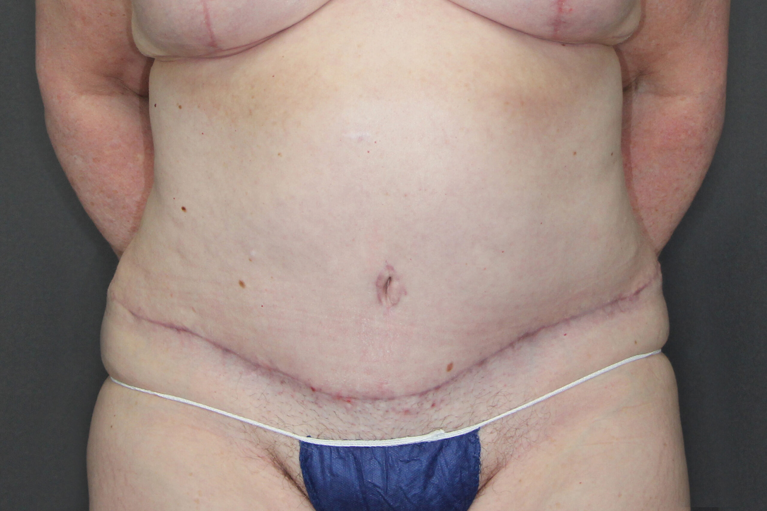 Case--1208 | After Body Procedures