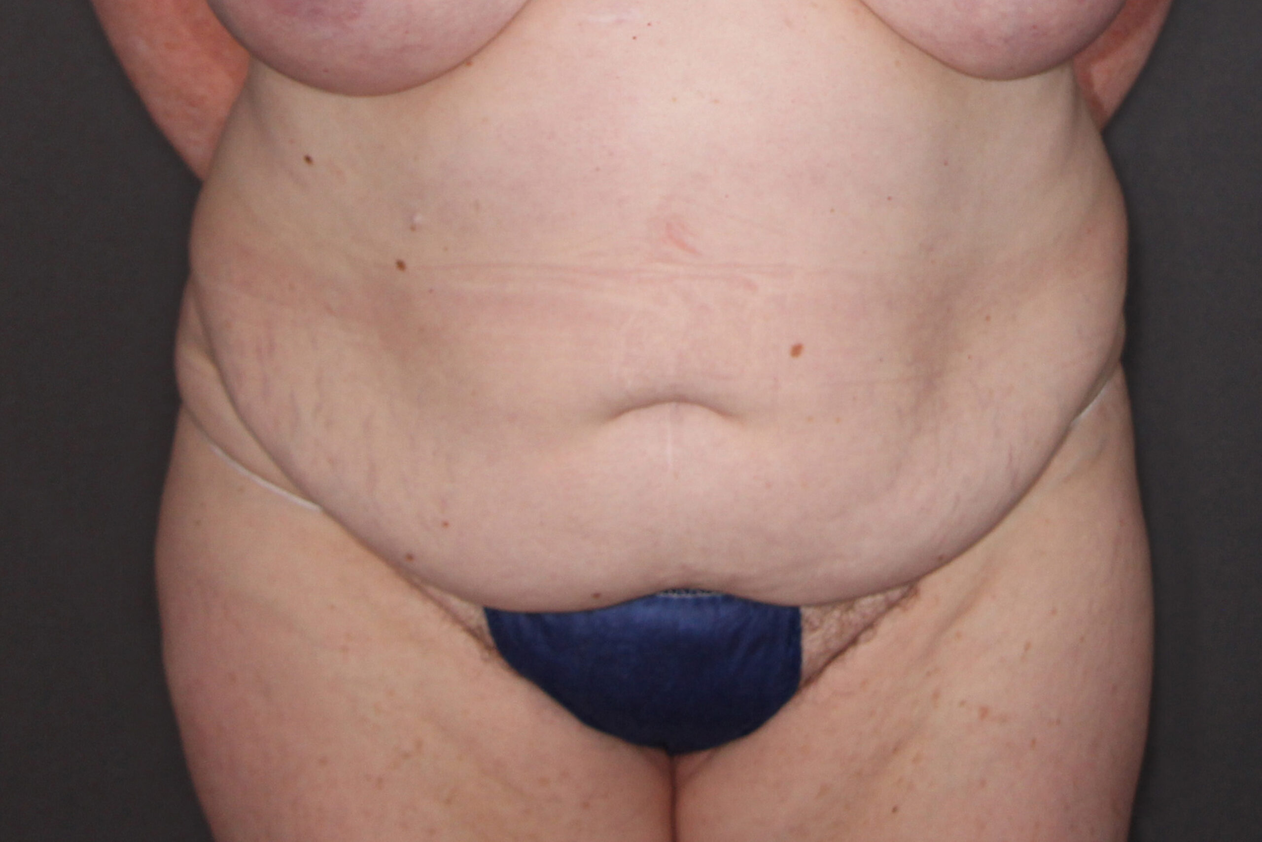 Case--1208 | Before Body Procedures