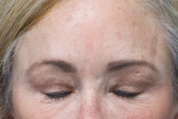 Case--5695 | After Blepharoplasty