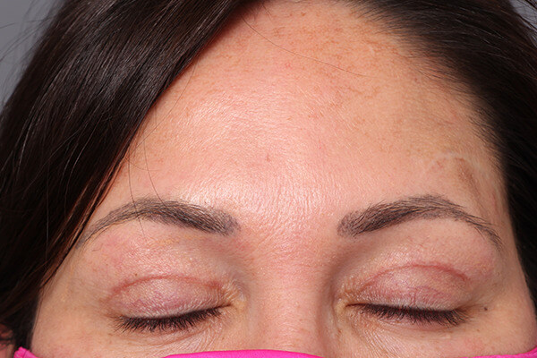 Case--7616 | After Blepharoplasty