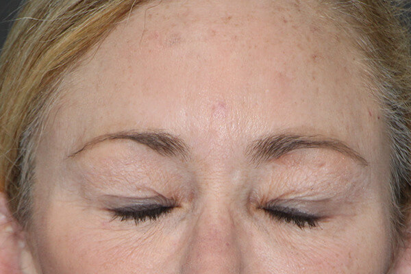Case--5695 | Before Blepharoplasty