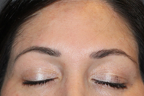 Case--7616 | Before Blepharoplasty