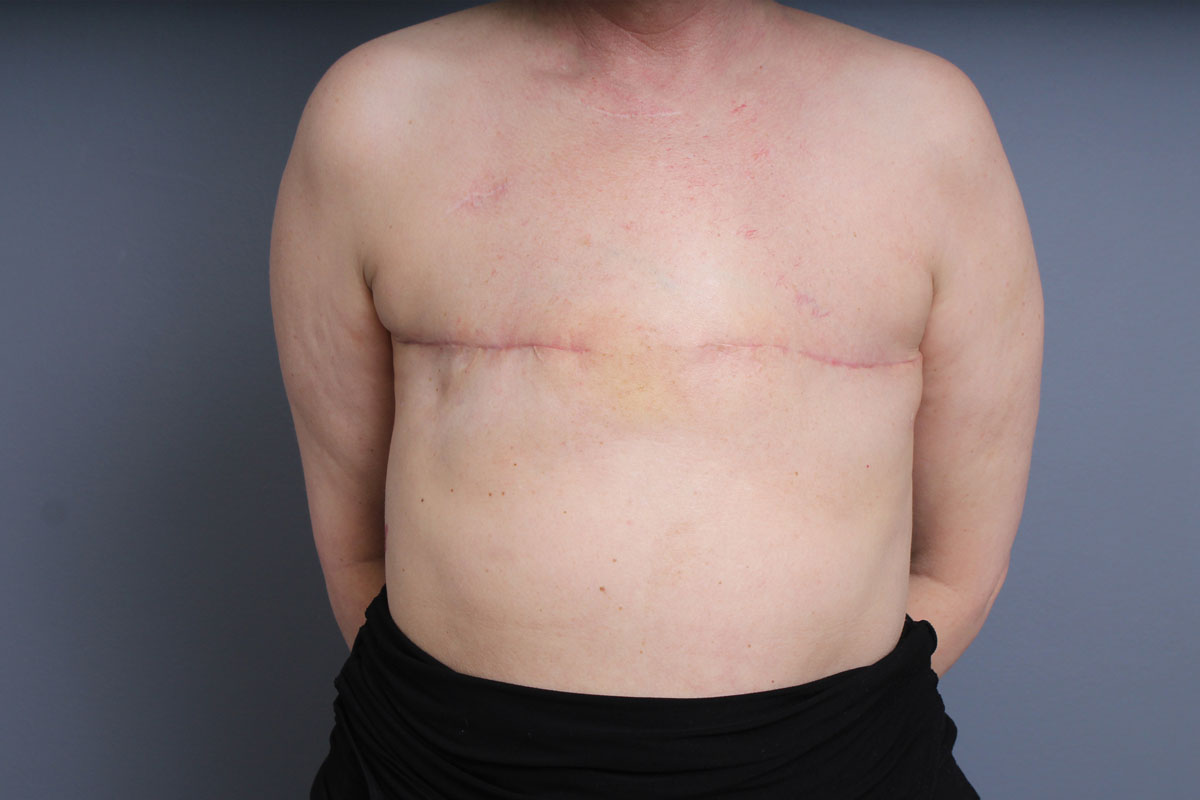 After Aesthetic Flap Closure 01