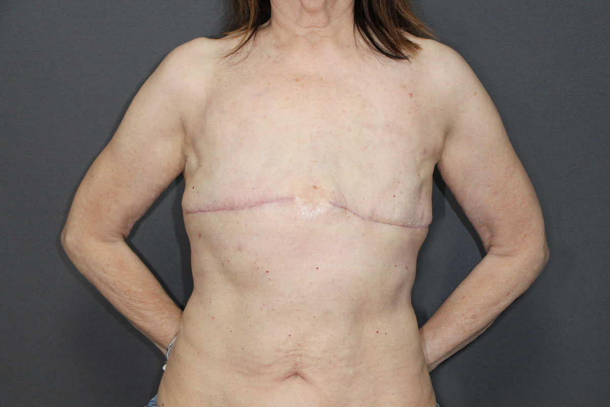 After Aesthetic Flap Closure 02