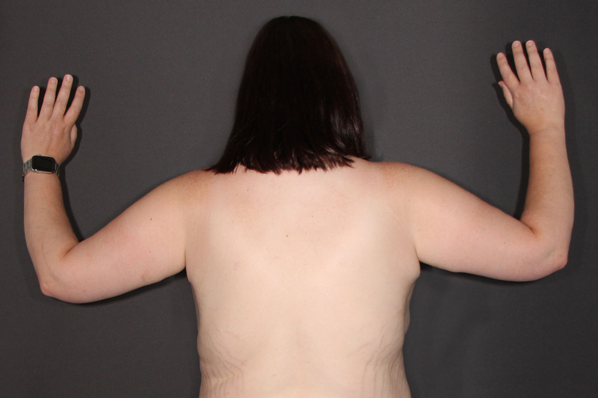 After Arm Lift 01 Back view