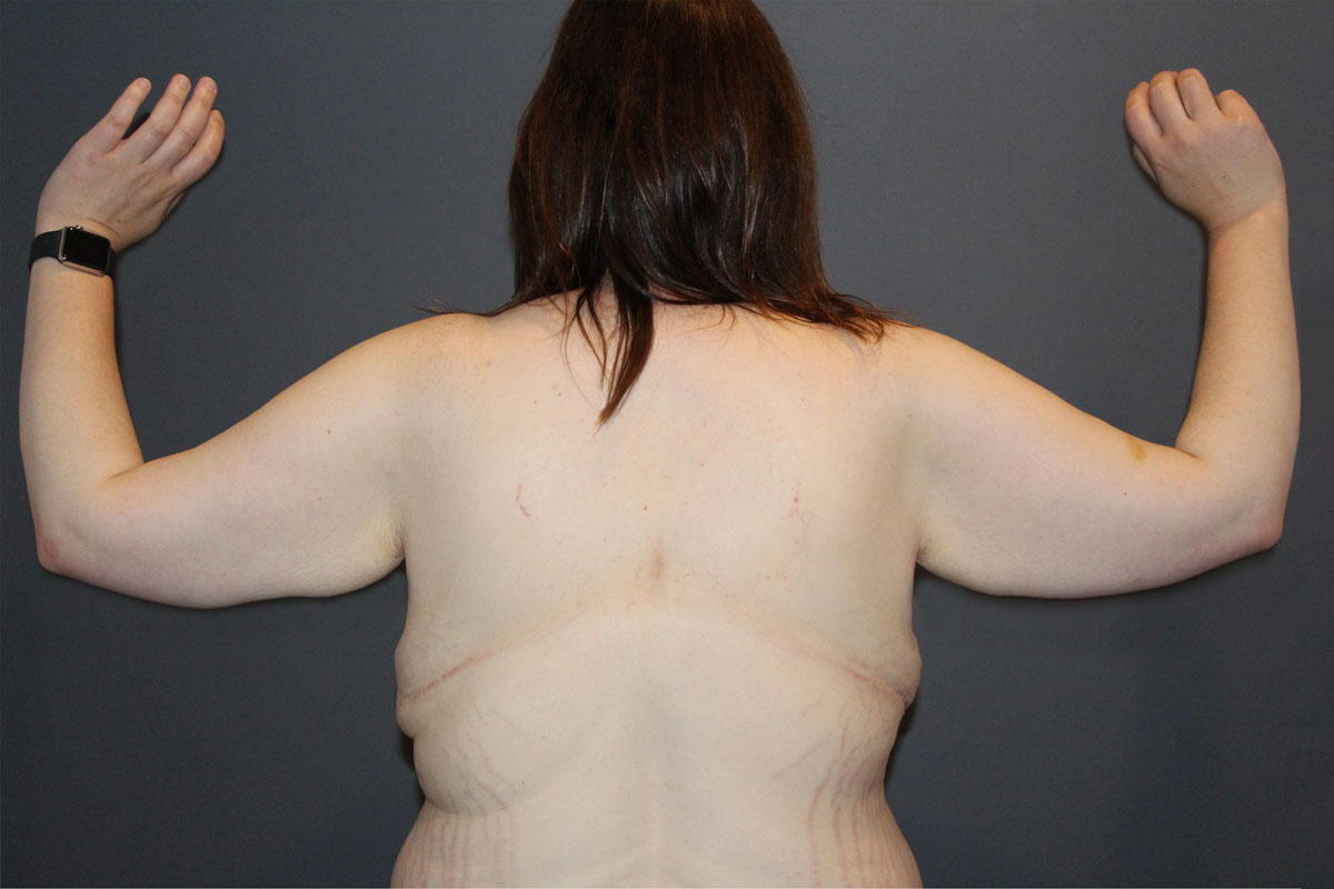 Before Arm Lift 01 Back view