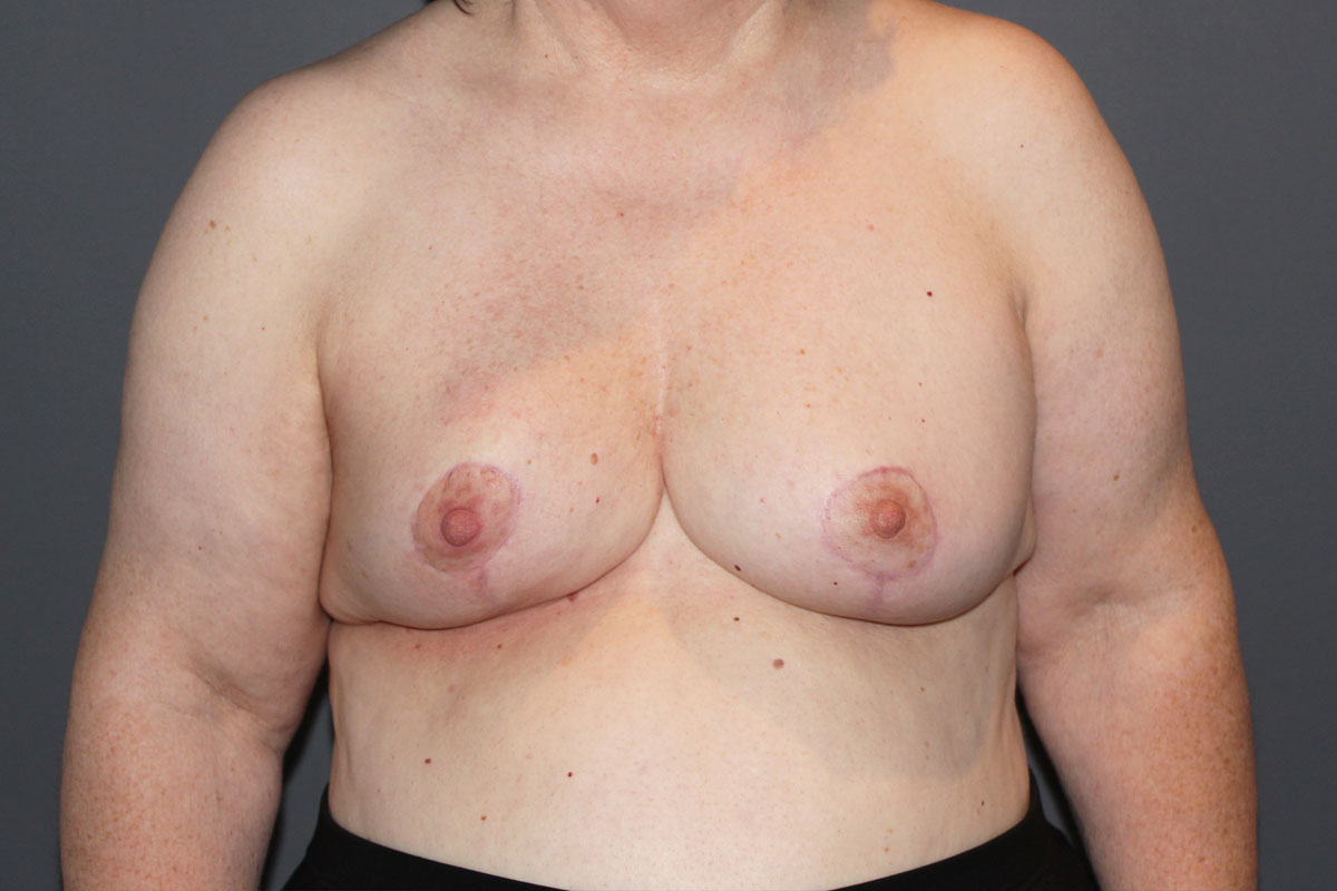 After Oncoplastic Reduction 01