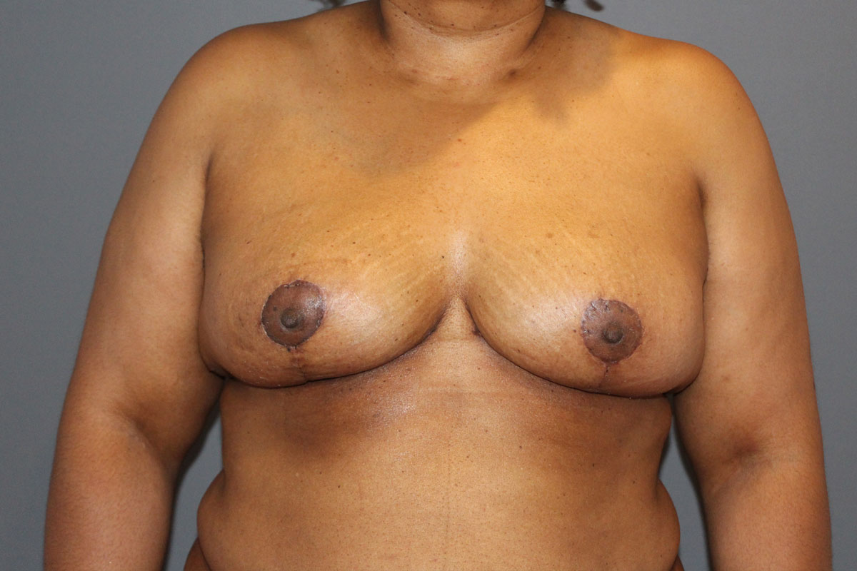 After Oncoplastic Reduction 02