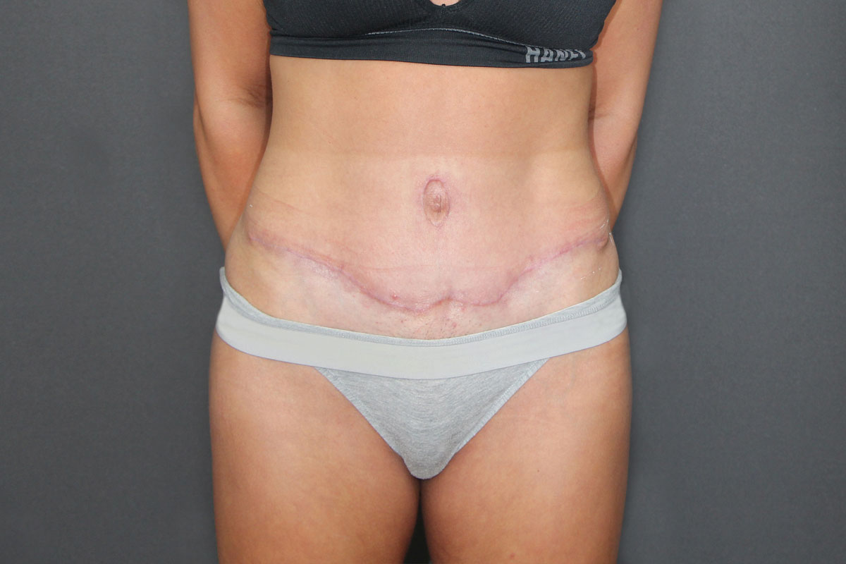 After Abdominoplasty 05