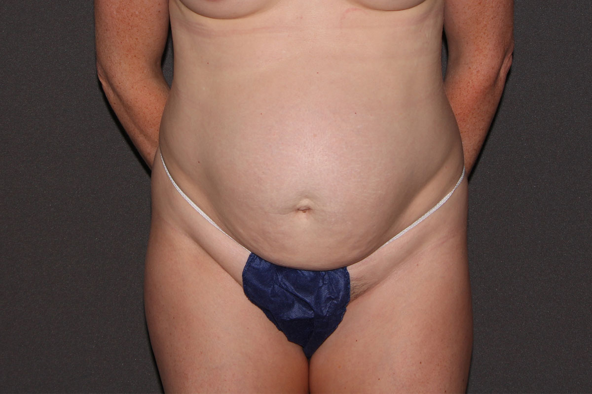Before Abdominoplasty 03